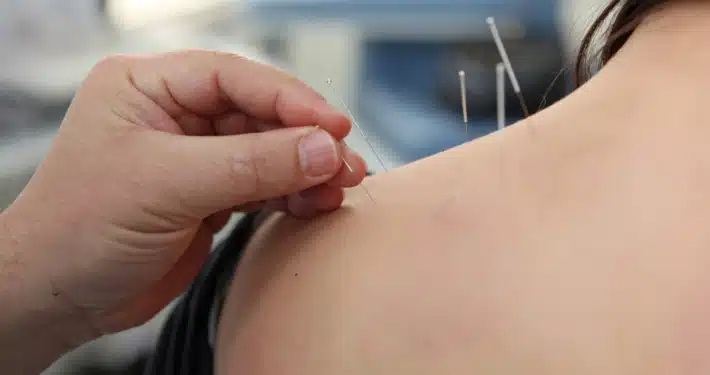 acupuntura china colocación de agujas en hombro